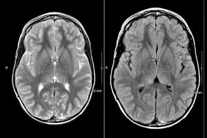 MRIOnline Mastery Series: Neurofibromatosis Type 1 (NF1) 2021