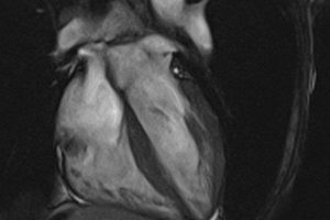 MRIOnline Mastery Series: Cardiac MRI of Non-Ischemic Cardiomyopathy 2021